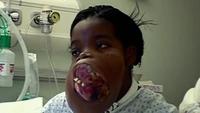 Extraordinary People: My Face is Eating Me Alive