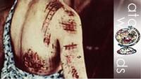 Atomic Wounds