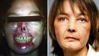 The World's First Face Transplant